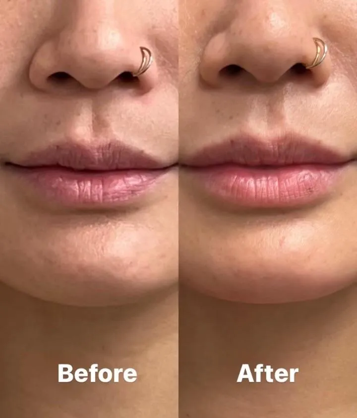 Cosmetic Fillers