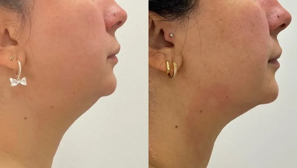 Client body contouring before and after results