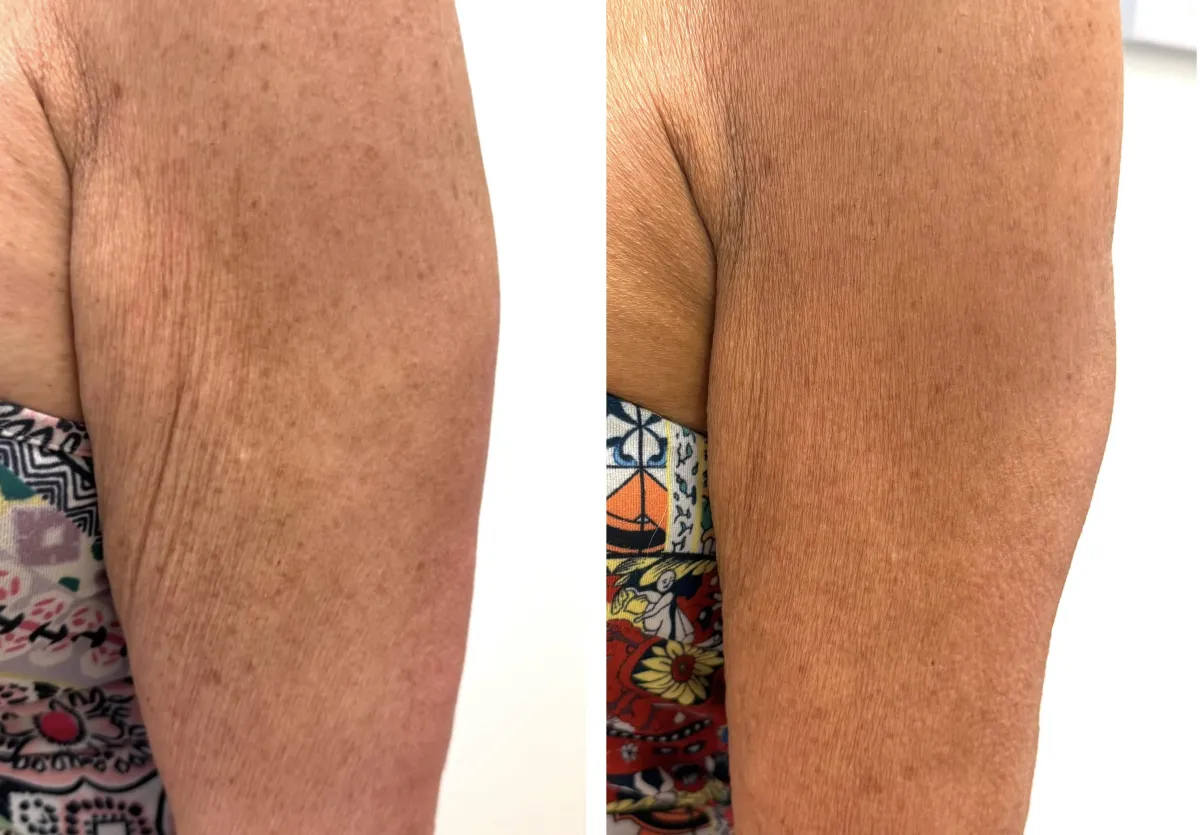 Visibly contoured body results following spa treatment