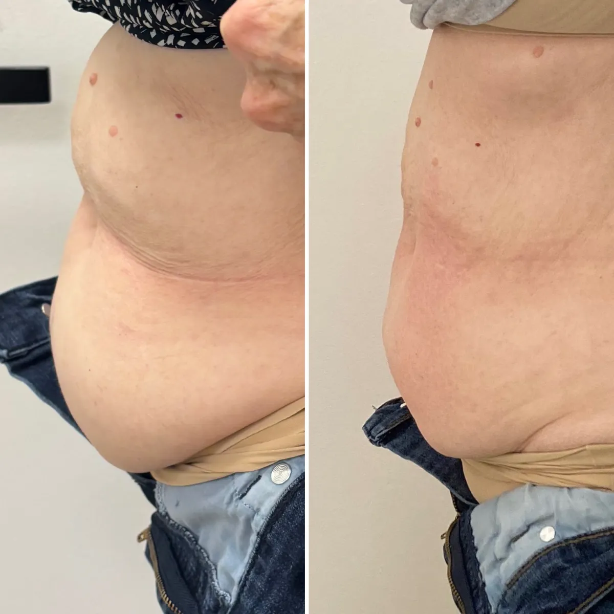 Client body contouring before and after results