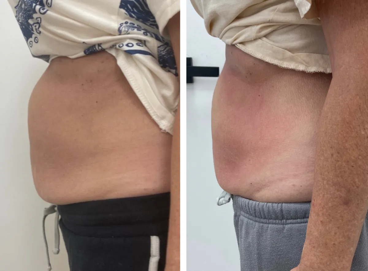 Visibly contoured body results following spa treatment