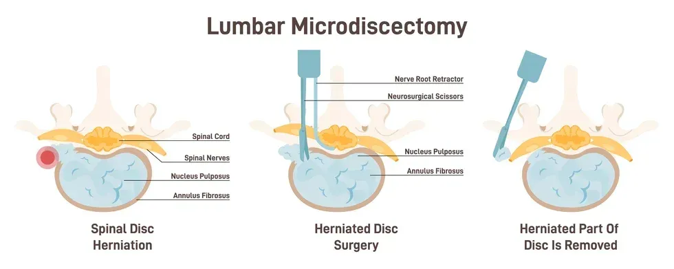 Back Surgery FAQs