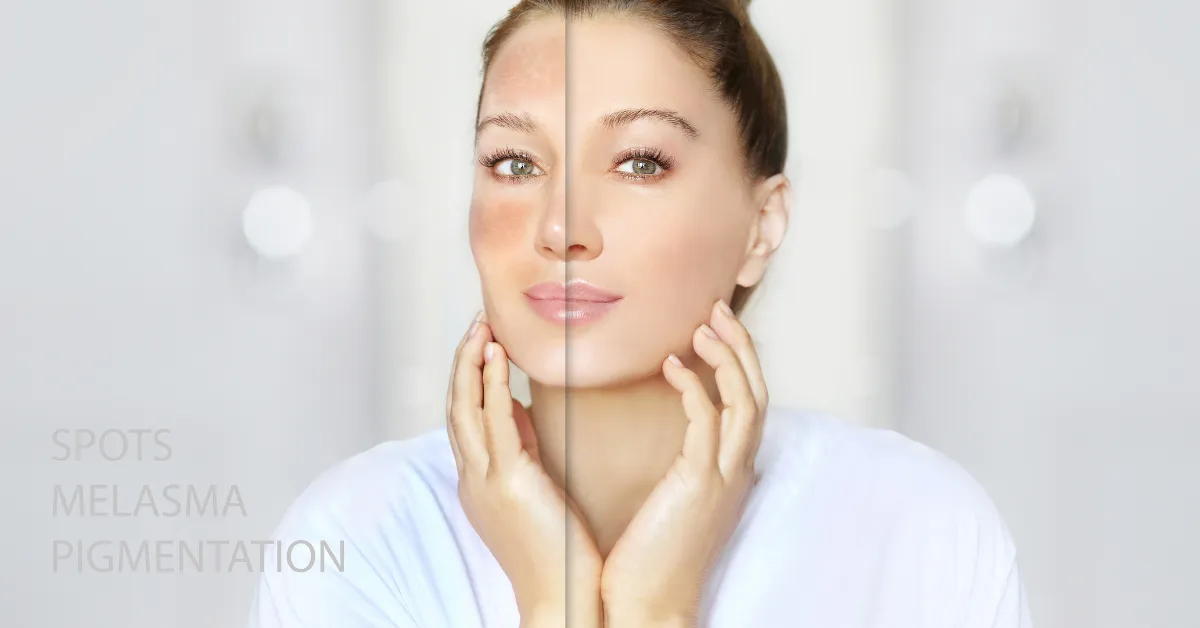 Before and after Aerolase laser treatment for melasma and sun spots on the face and forehead at Beauty Diamond Medispa & Aesthetics