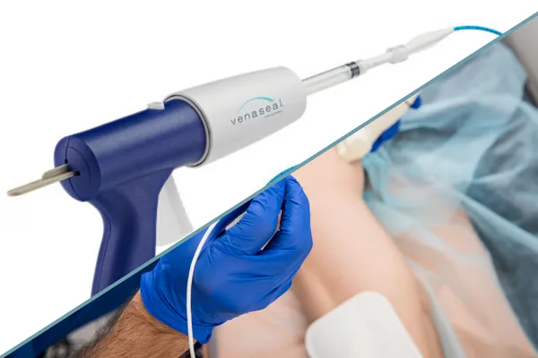 Radiofrequency Ablation or Venaseal™: What's Best For You?