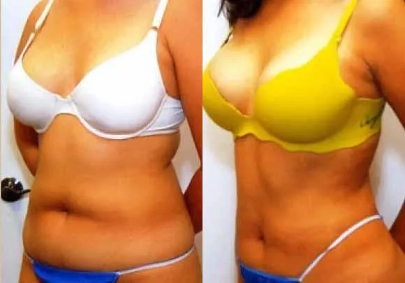 Laser Liposuction before and after