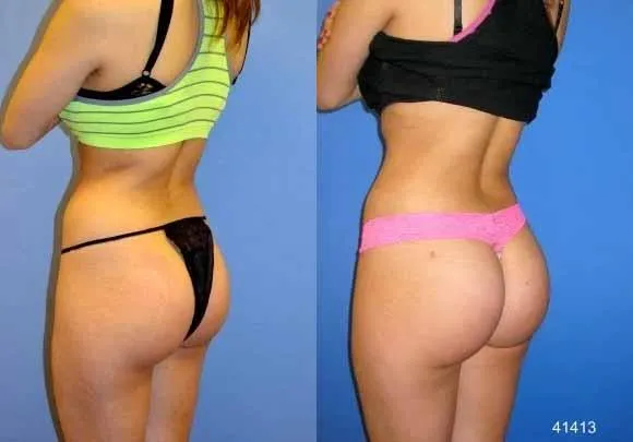 Laser Liposuction before and after