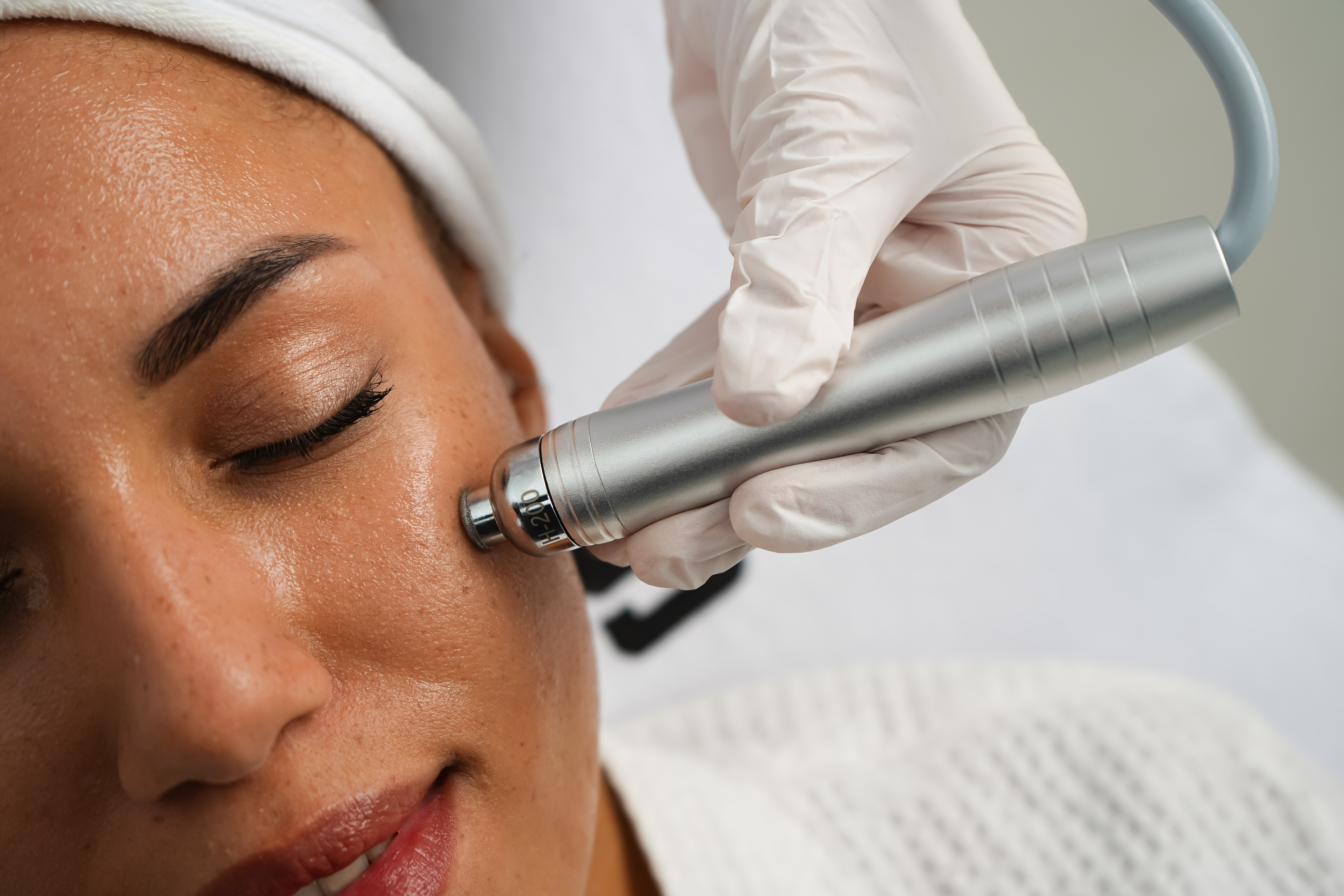 Clinical application of the HydroDiamond handpiece delivering diamond exfoliation and serum infusion on a patient