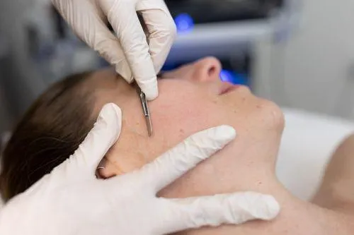 Professional dermaplaning treatment in West Bloomfield skincare clinic