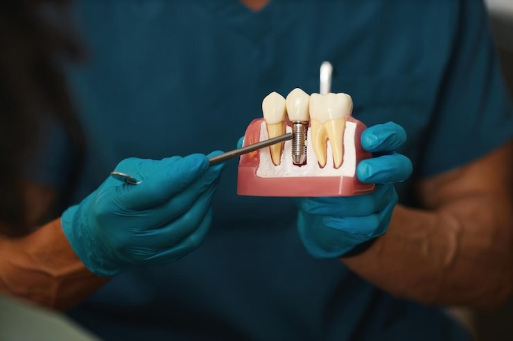 how to care for dental implants