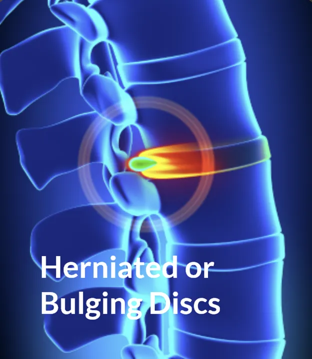 Herniated or Bulging Discs