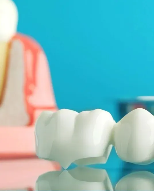 Close-up of a dental crown restoration being positioned on a tooth model.