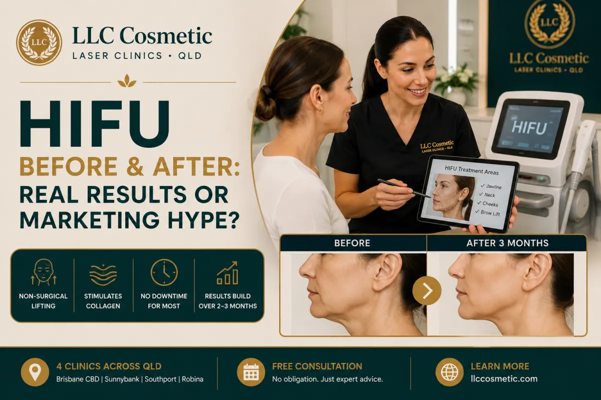HIFU before and after results showing realistic skin tightening and jawline definition