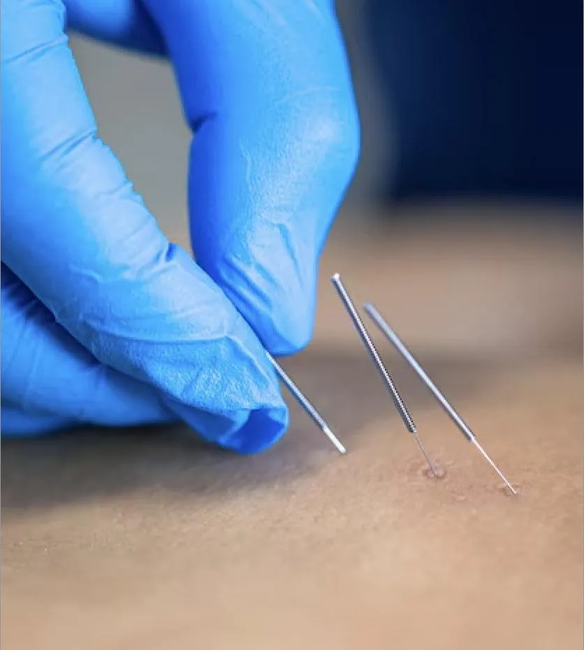 Dry needling Murray Ky Hometown Chiropractor