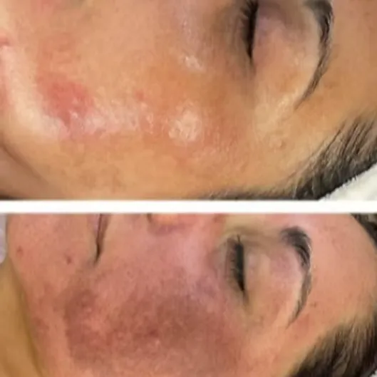 Melasma 