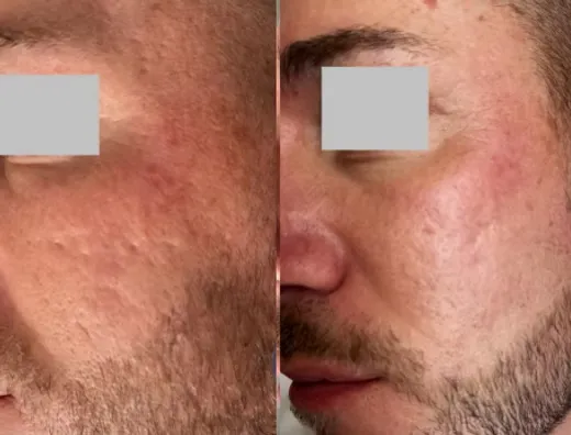 Seeing a Licensed Aesthetician for Acne 