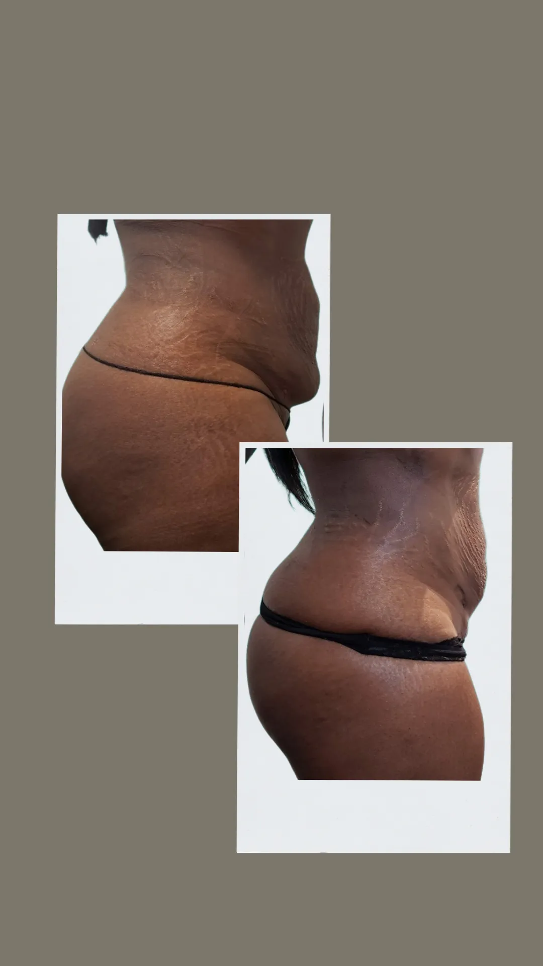 toronto post op brazilian lymphatic drainage massage after tummy tuck