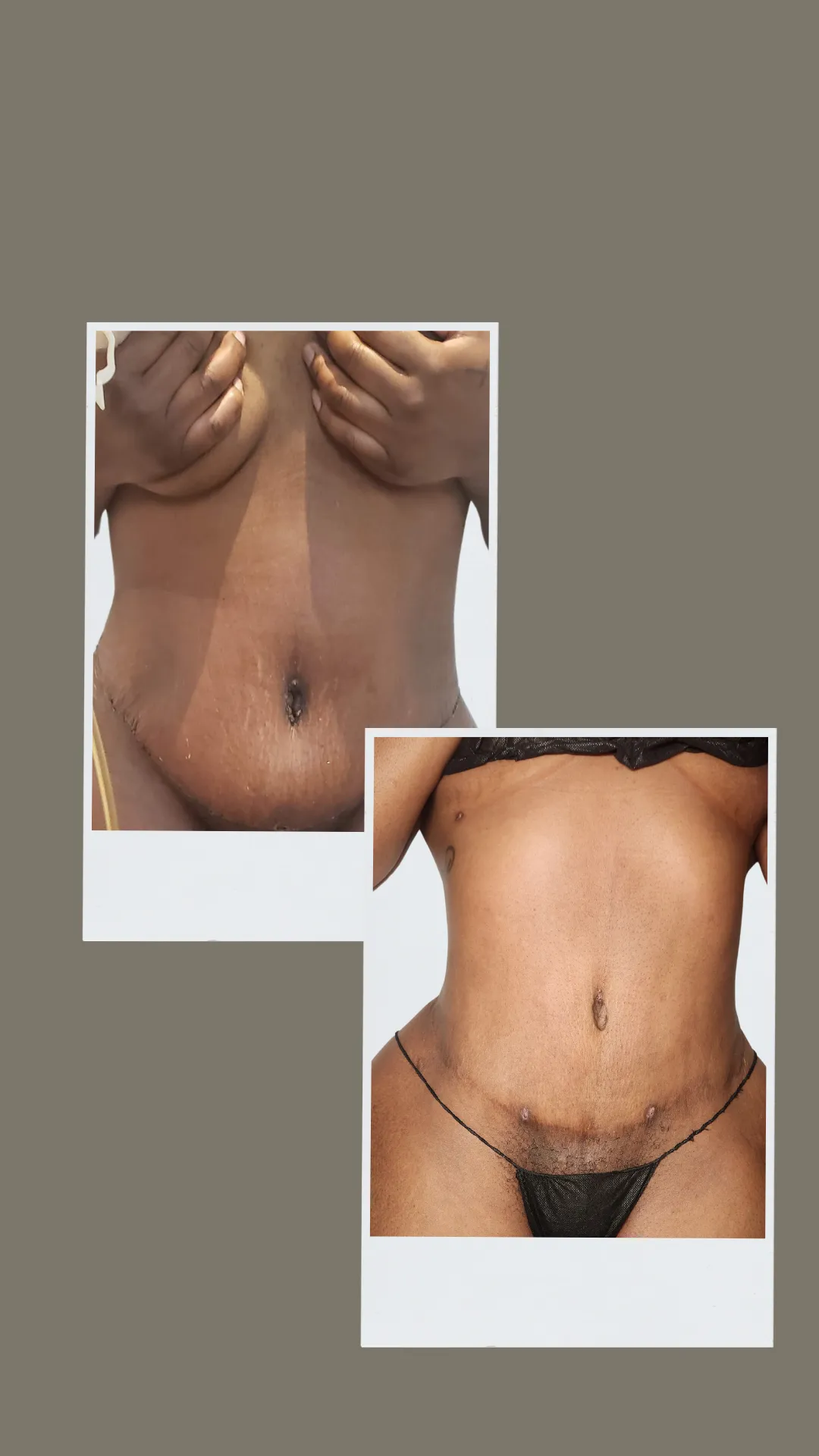 toronto post op brazilian lymphatic drainage massage after lipo