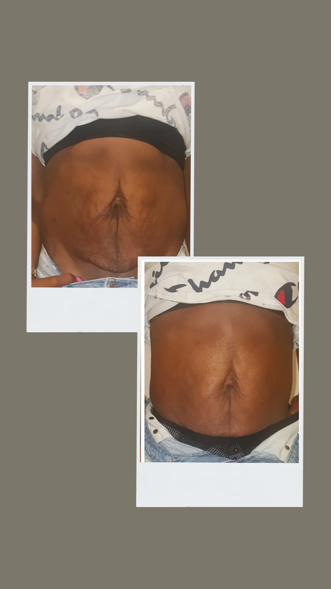 body contouring and post op lymphatic drainage massage therapy non invasive body sculpting fat loss