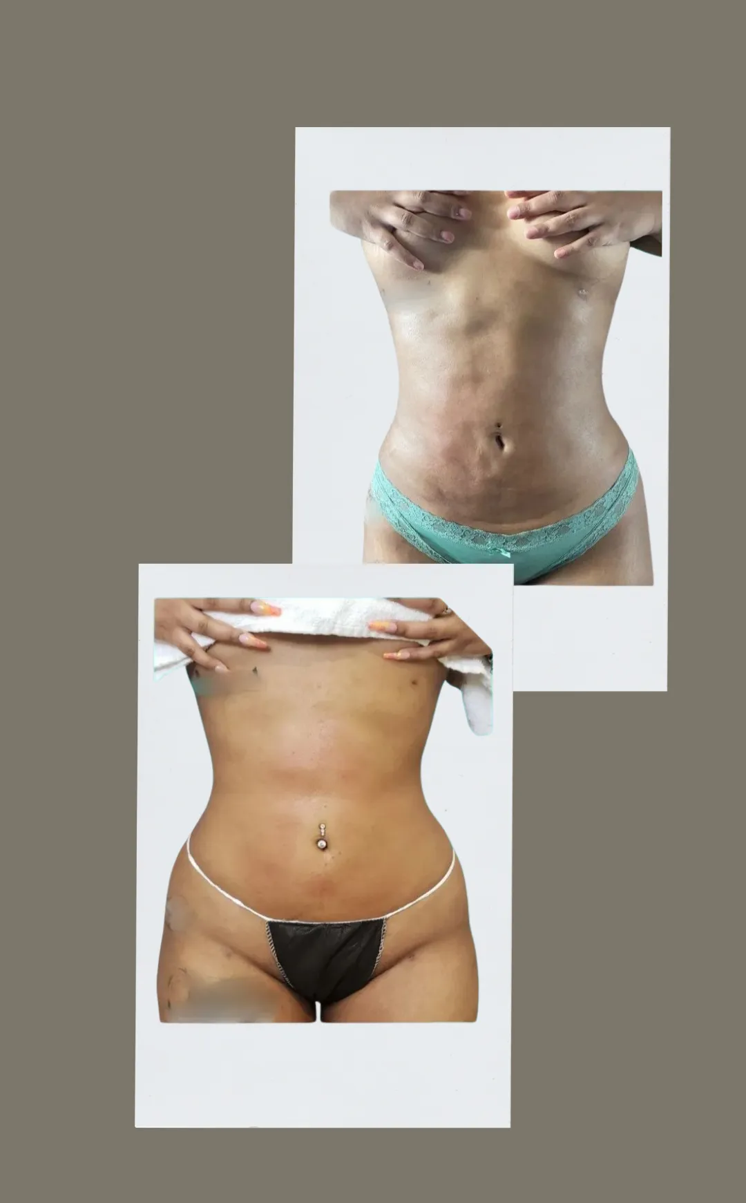 toronto post op brazilian lymphatic drainage massage after surgery