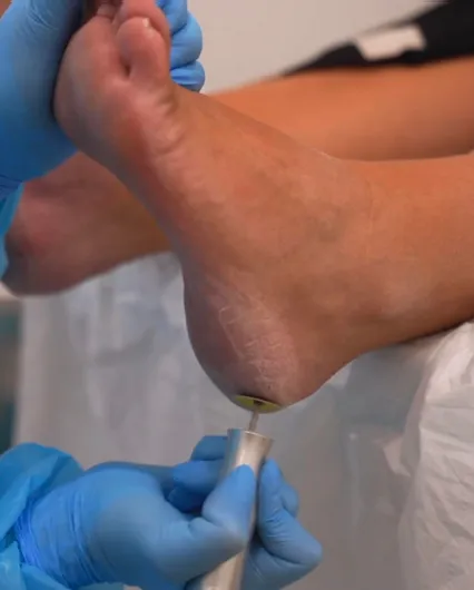 Heel Debriding