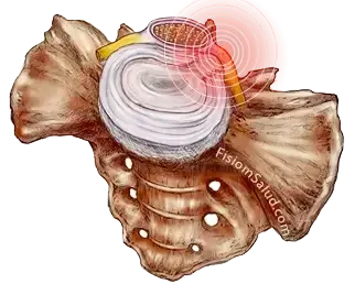 hernia discal