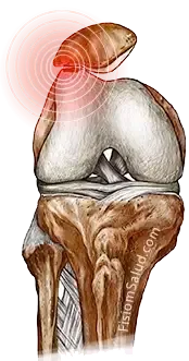 dolor de rodilla