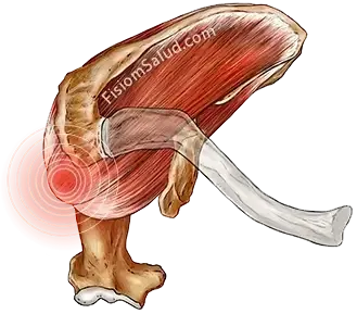 tendinitis del supraespinoso