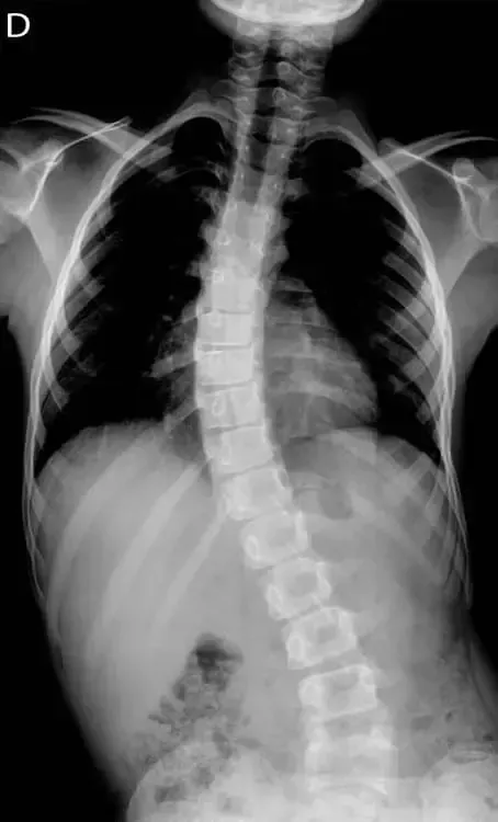 radiografia escoliosis