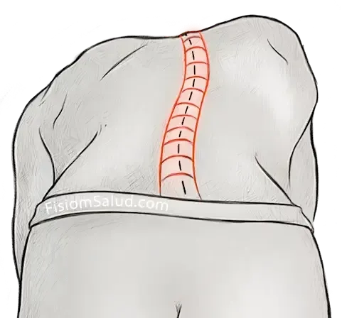 dolor dorsal escoliosis