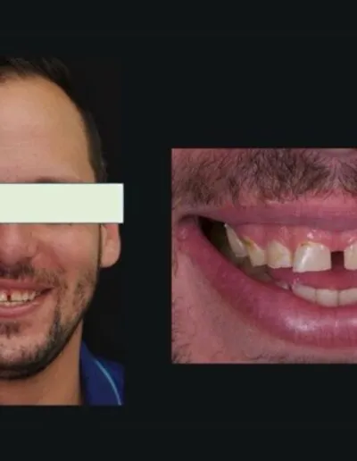 Before Treatment