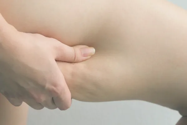 A trabajar contra la Celulitis