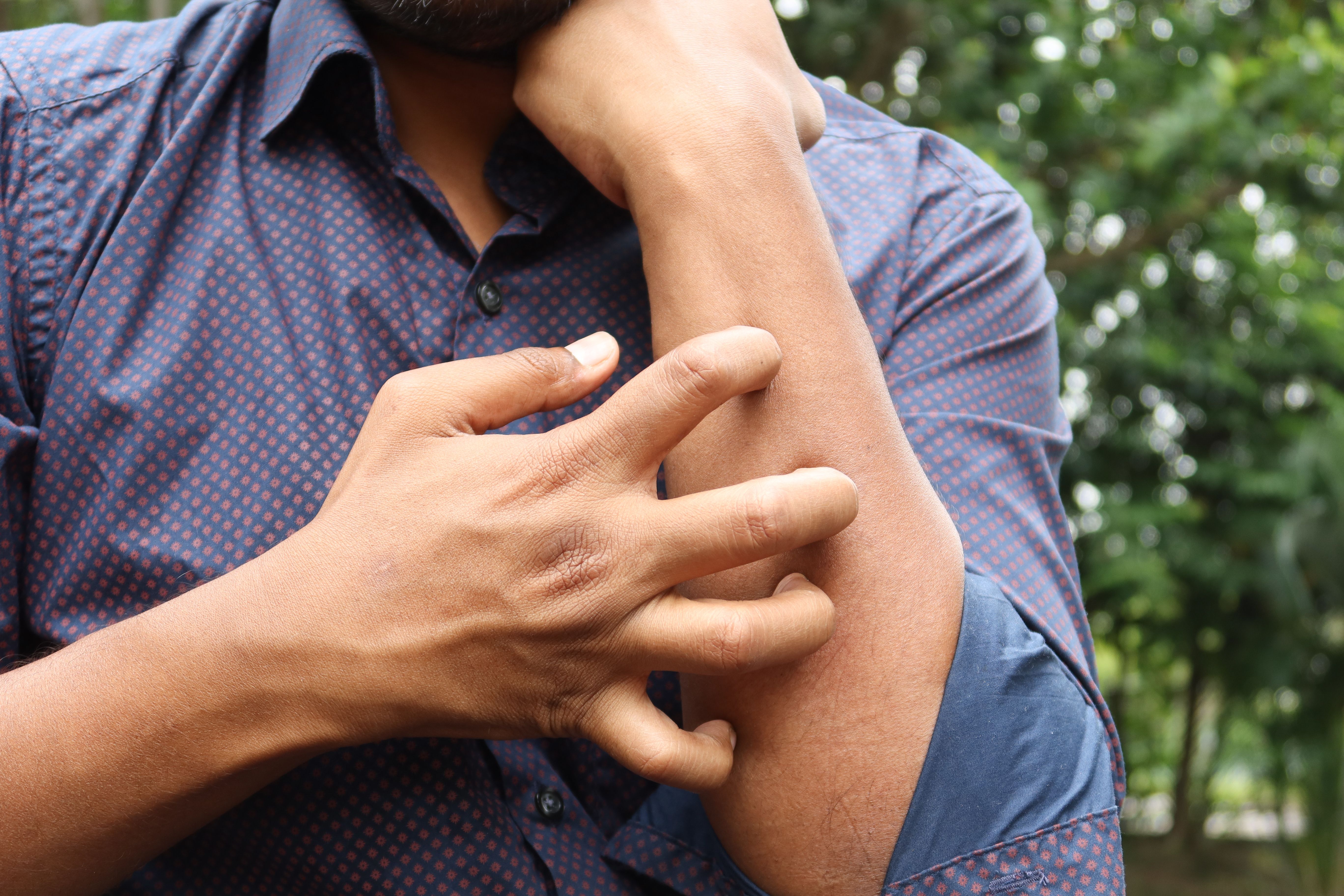 Dermatitis por calor en verano: cómo identificarla y cuidar tu piel