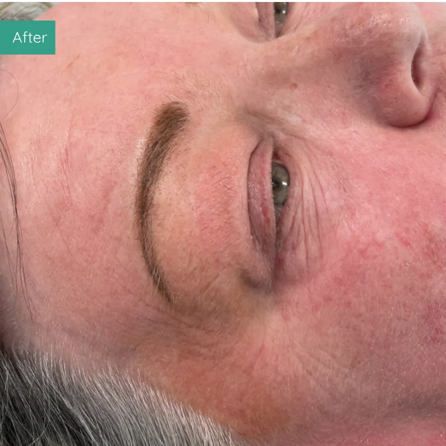 After image of client from PMU Dorset