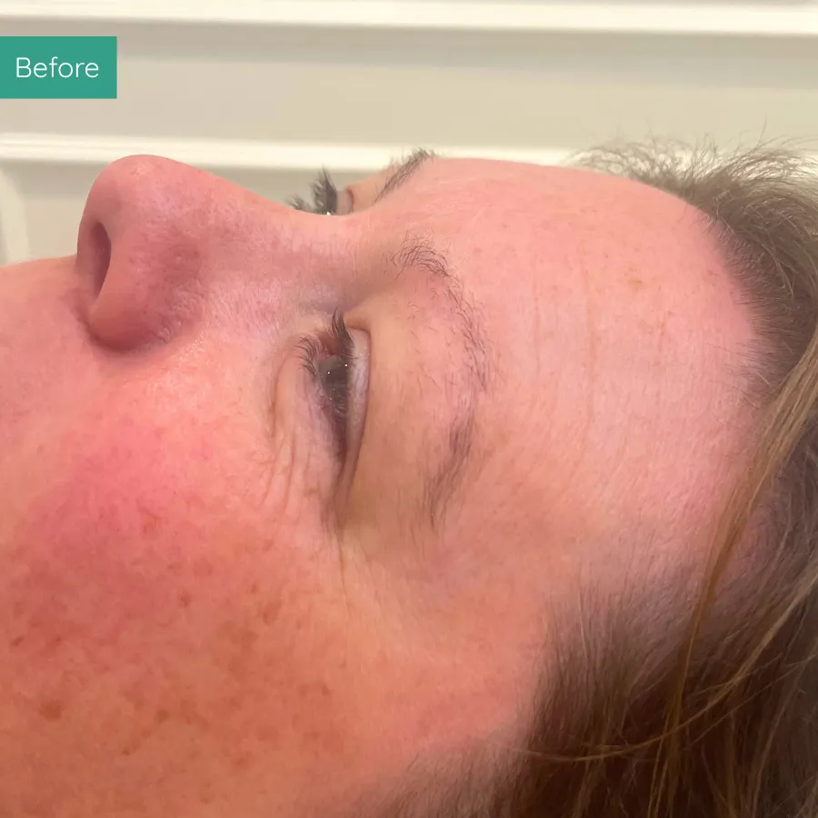 Before image of client from PMU Dorset