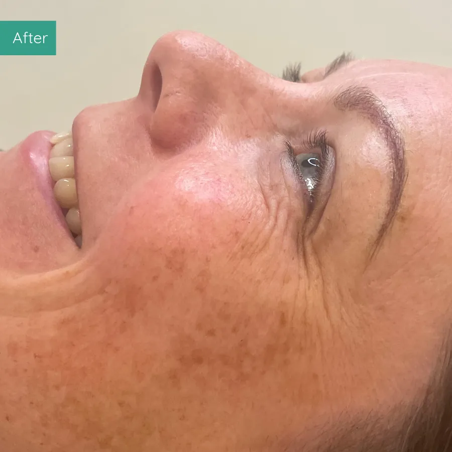 After image of client from PMU Dorset