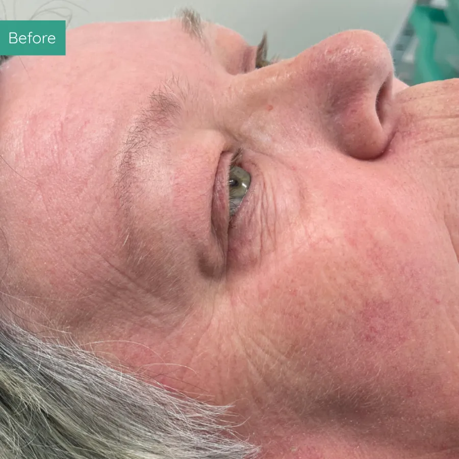 Before image of client from PMU Dorset