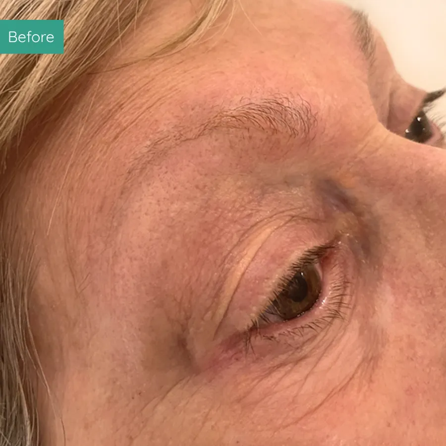 Before image of client from PMU Dorset