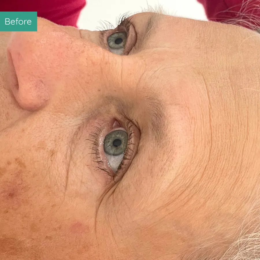 Before image of client from PMU Dorset