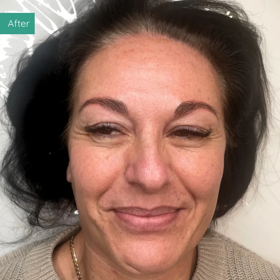 After image of client from PMU Dorset