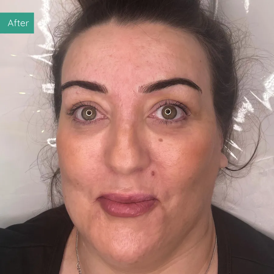 After image of client from PMU Dorset