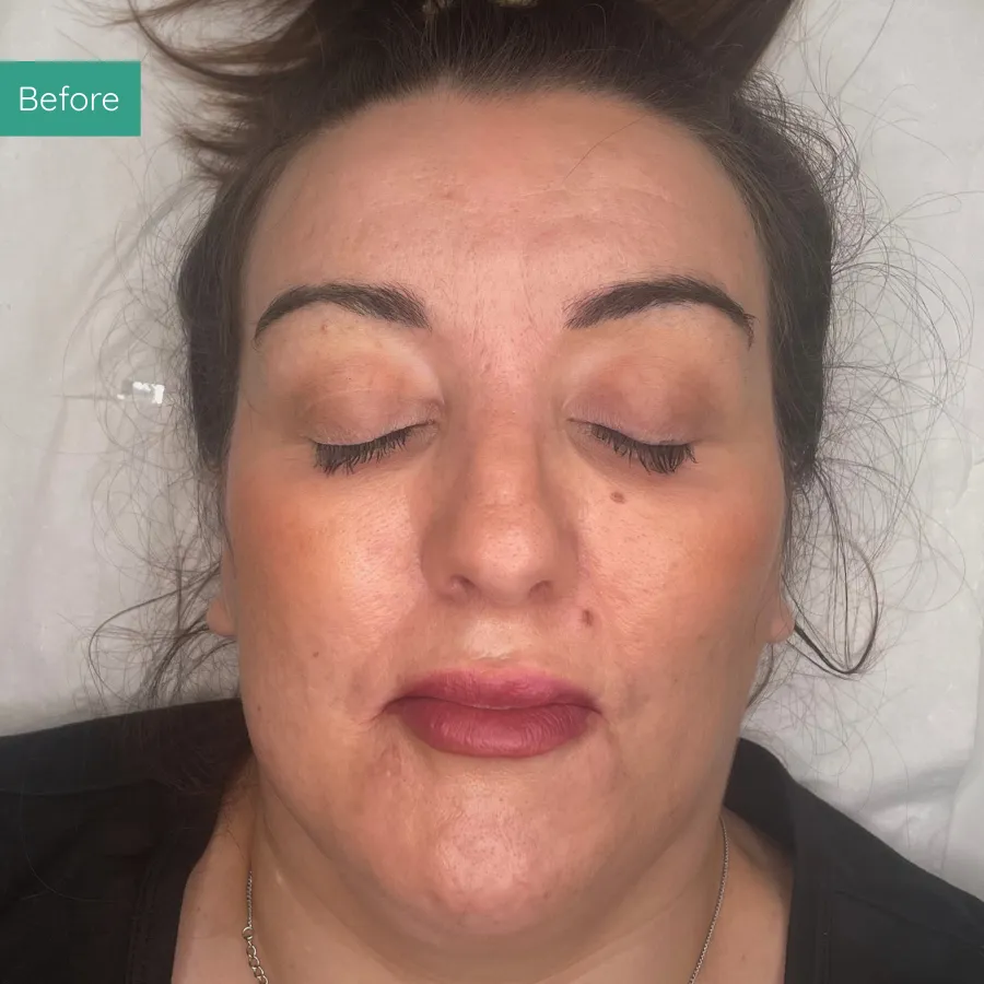 Before image of client from PMU Dorset