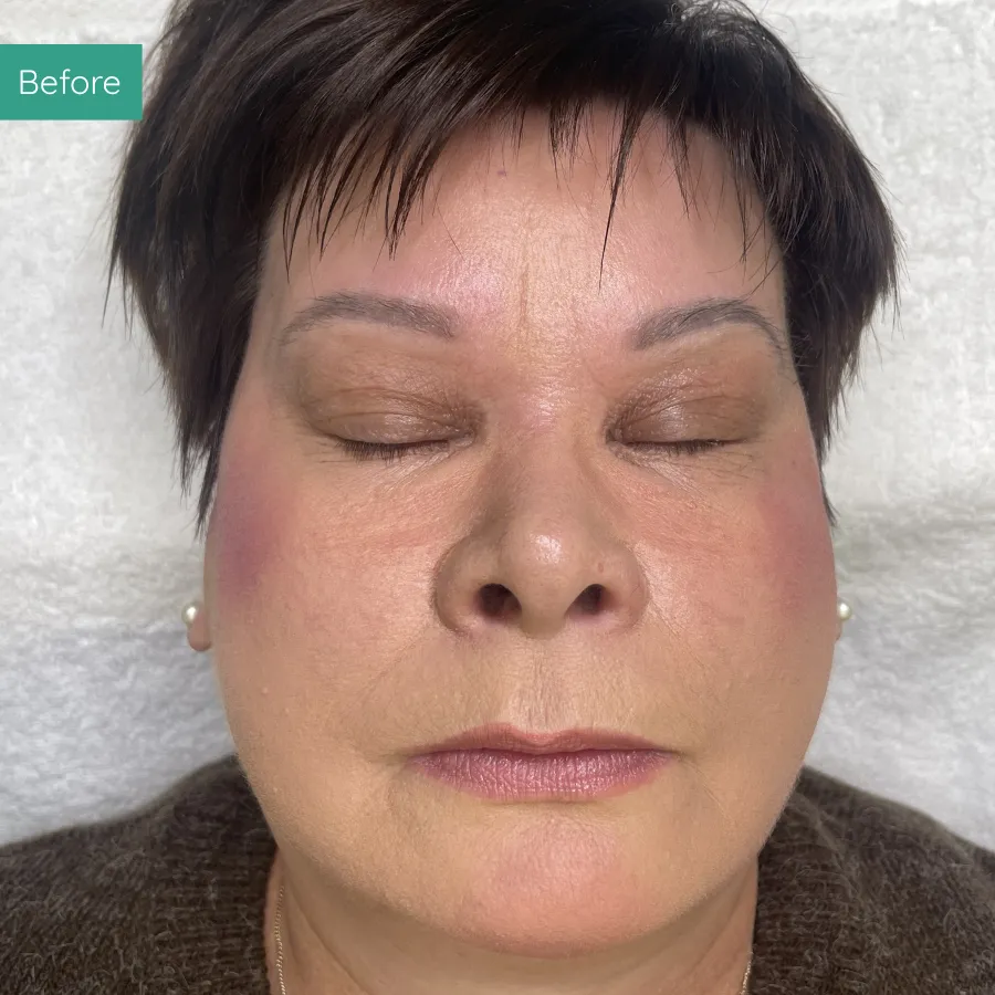 Before image of client from PMU Dorset