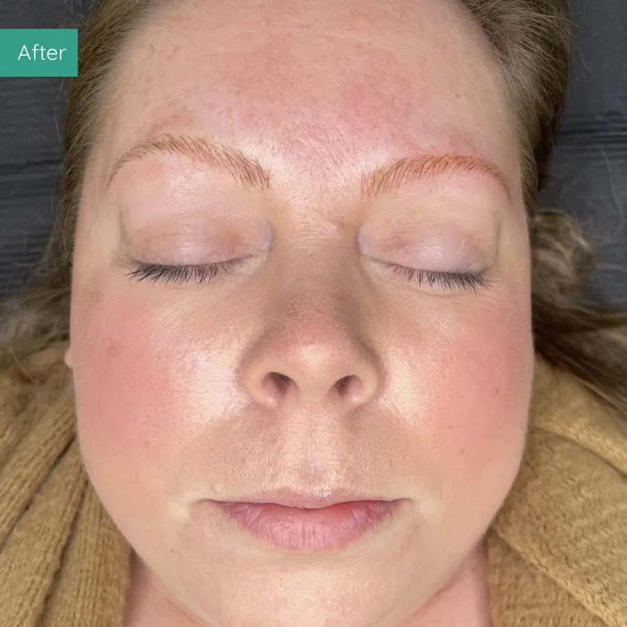 After image of client from PMU Dorset