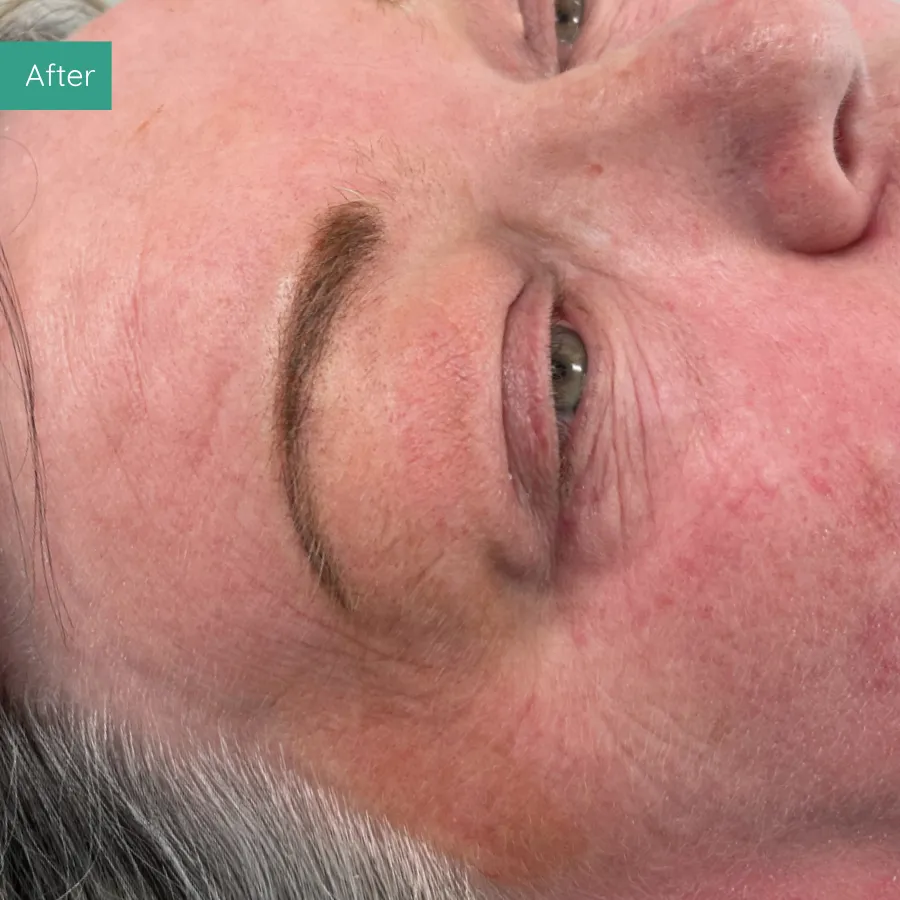 After image of client from PMU Dorset