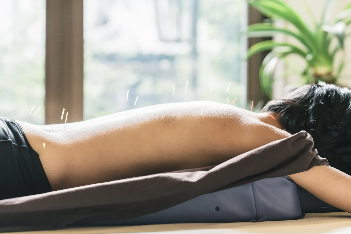 Acupuncture