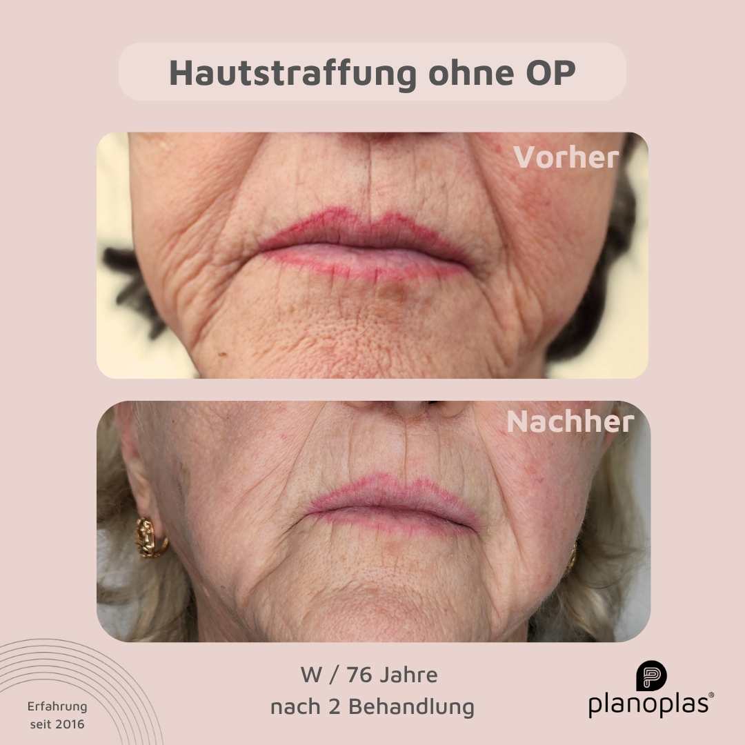 Sichtbare Ergebnisse der planoplas® Plasma Pen Mundbereich Behandlung