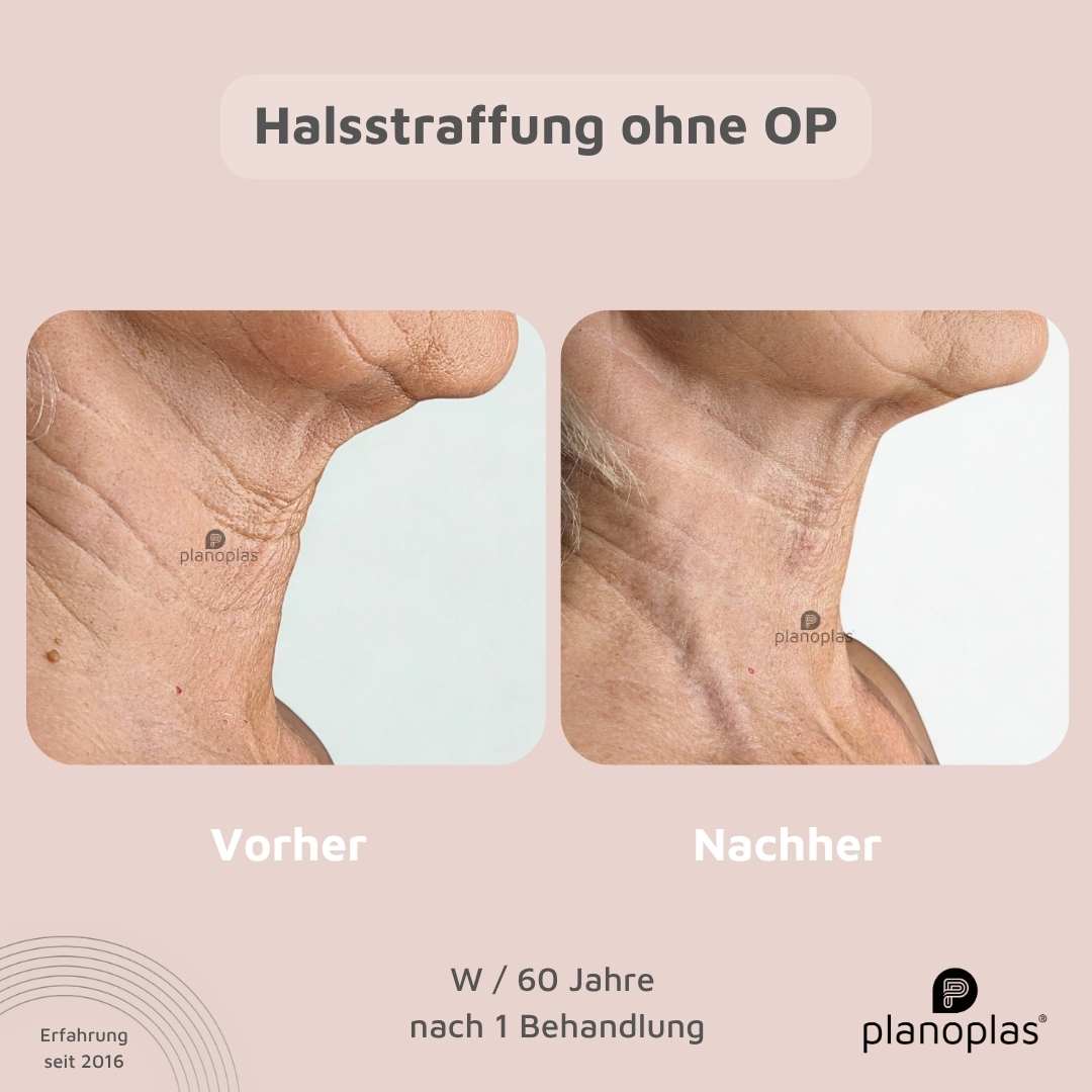 Vorher-Nachher planoplas® Plasma Pen Behandlung Halsstraffung