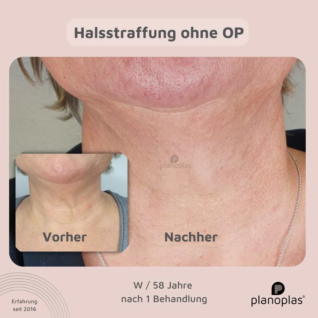 Vorher-Nachher planoplas® Plasma Pen Behandlung Halsstraffung