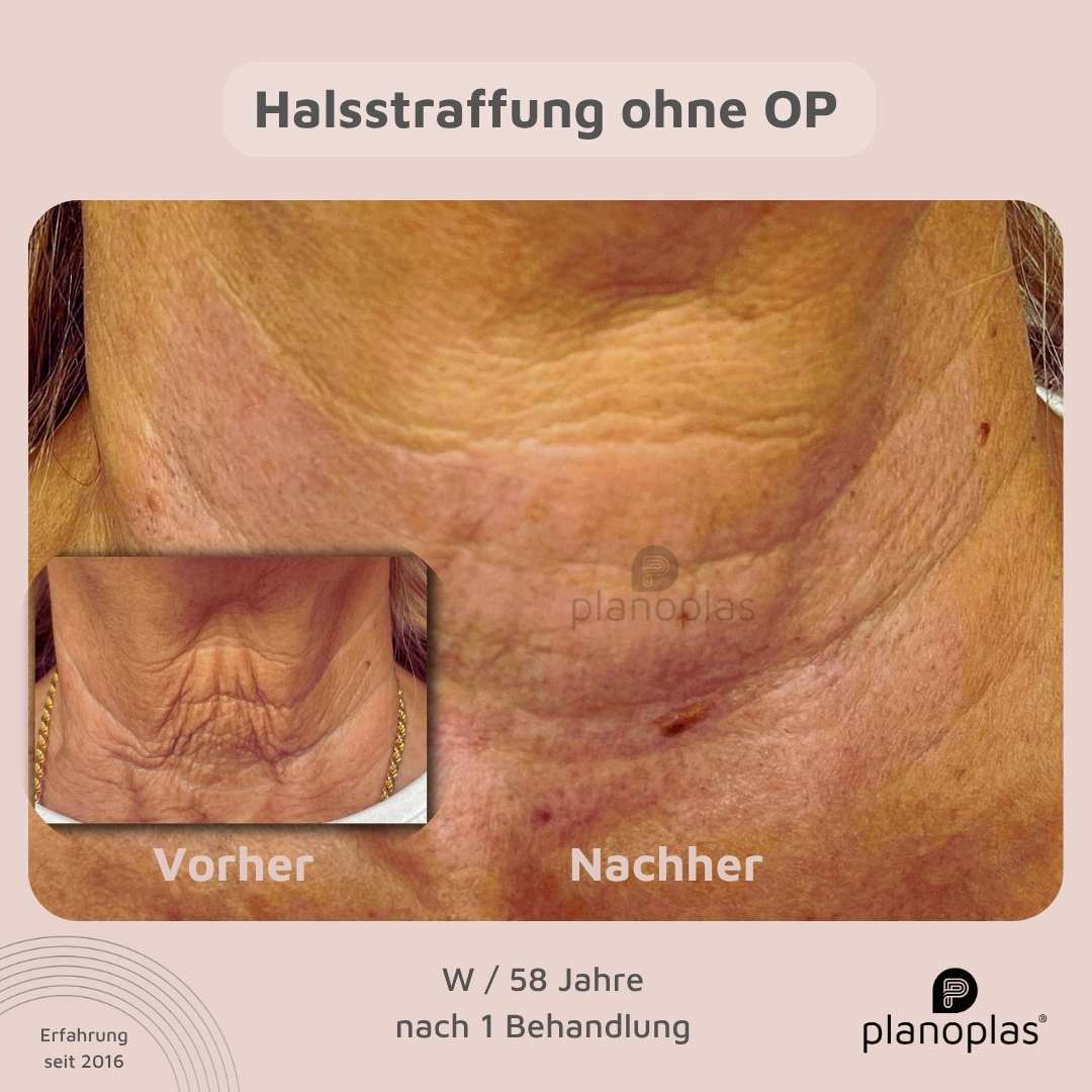 Vorher-Nachher planoplas® Plasma Pen Behandlung Halsstraffung