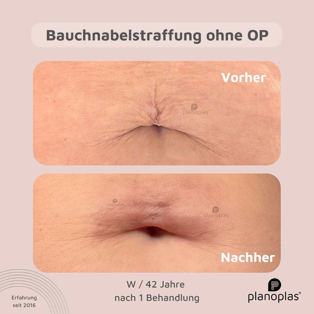 Vorher-Nachher planoplas® Plasma Pen Behandlung Aknenarben